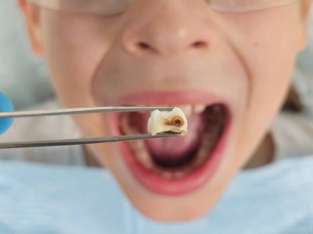 Best Emergency Wisdom Teeth Removal in Belle Plaine, KS
